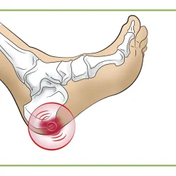Talonnettes pour épine calcanéenne Modèle femme